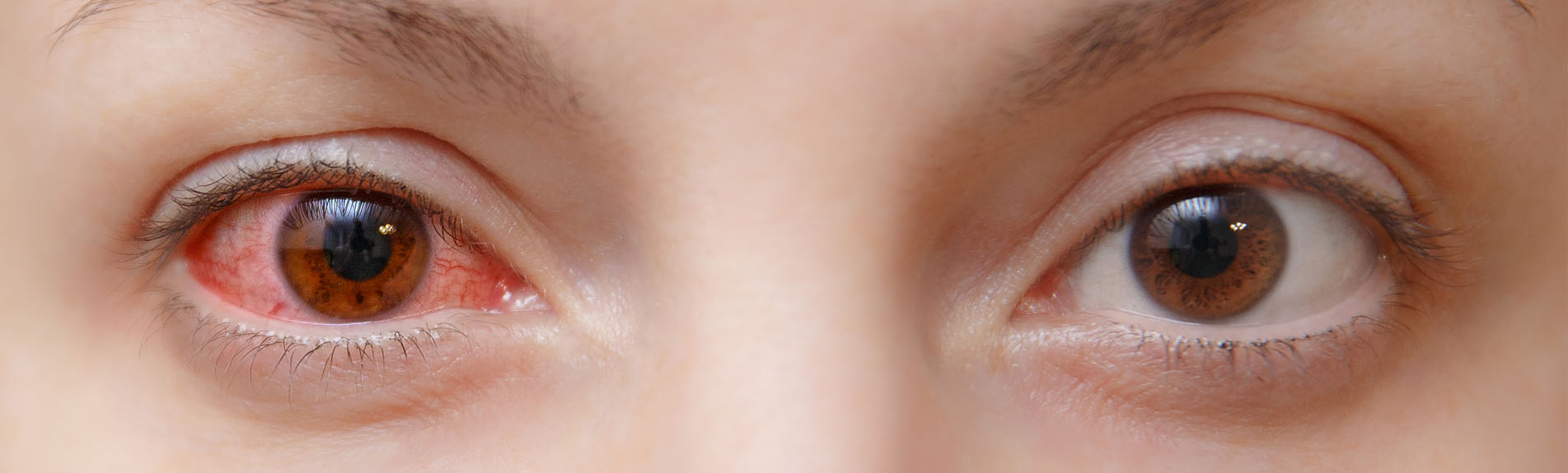 Conjunctivitis, pink eye